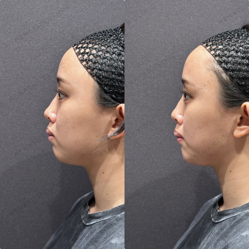 顎ヒアルロン酸ボラックス症例写真