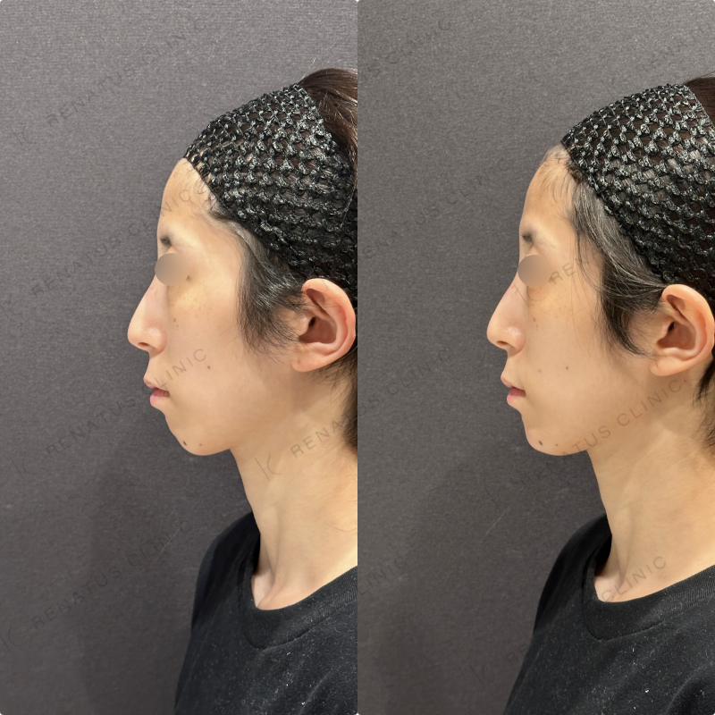 顎ヒアルロン酸ボラックス症例写真