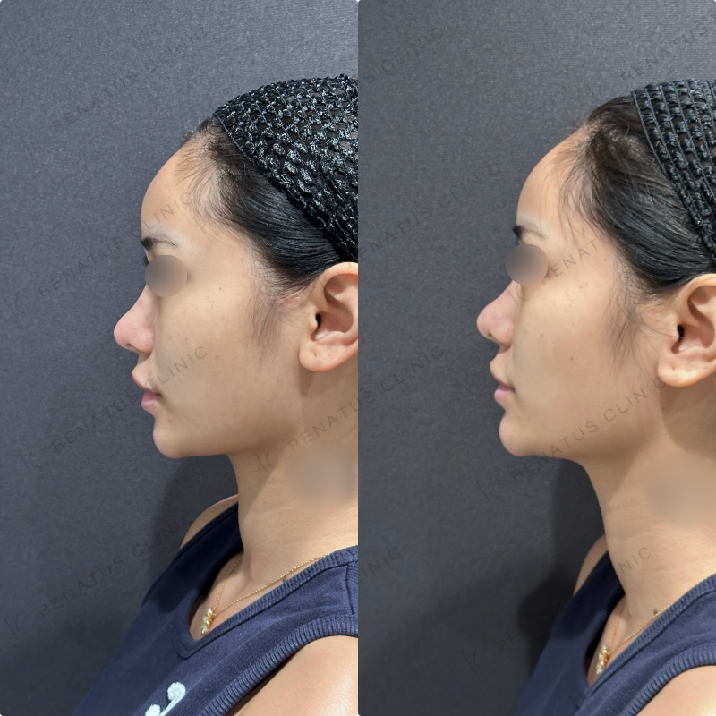 顎ヒアルロン酸ボラックス症例写真