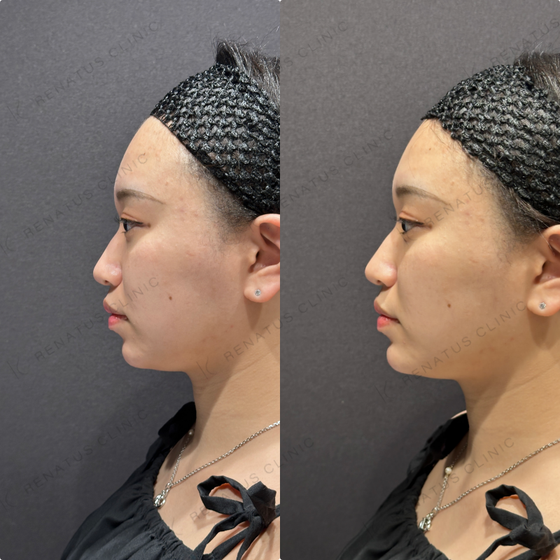 顎ヒアルロン酸ボラックス症例写真