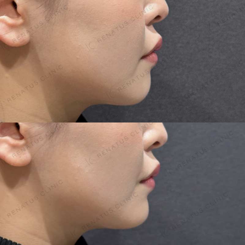 顎ヒアルロン酸ボラックス症例写真