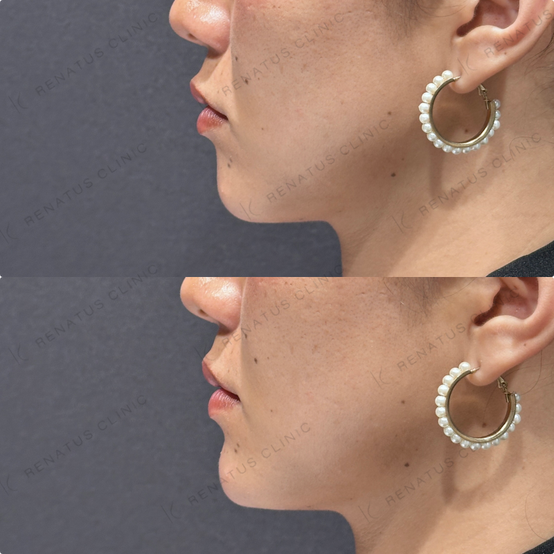 顎ヒアルロン酸ボラックス症例写真