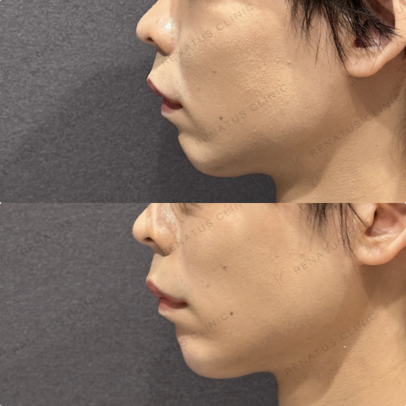 顎ヒアルロン酸ボラックス症例写真