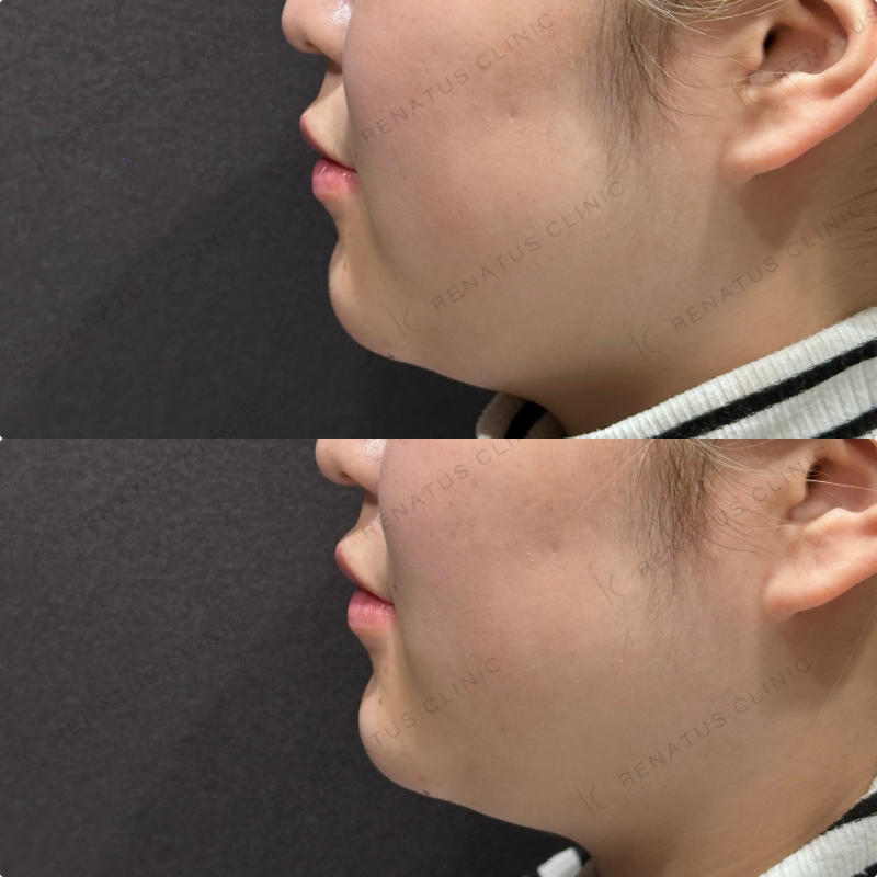 顎ヒアルロン酸ボラックス症例写真