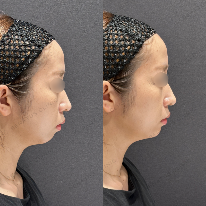 顎ヒアルロン酸ボラックス症例写真