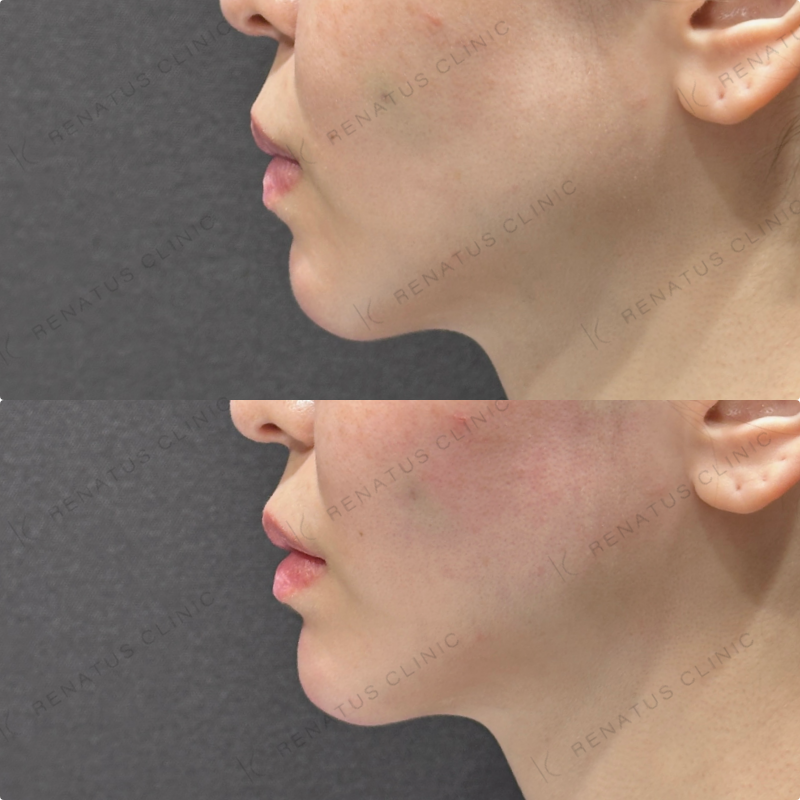 顎ヒアルロン酸ボラックス症例写真