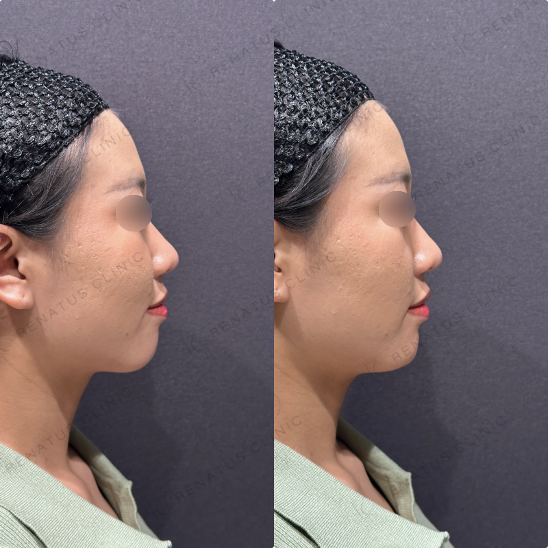 顎ヒアルロン酸ボラックス症例写真