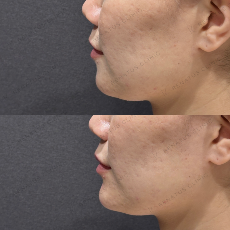 顎ヒアルロン酸ボラックス症例写真