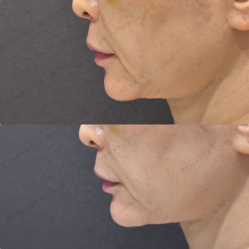 顎ヒアルロン酸ボラックス症例写真
