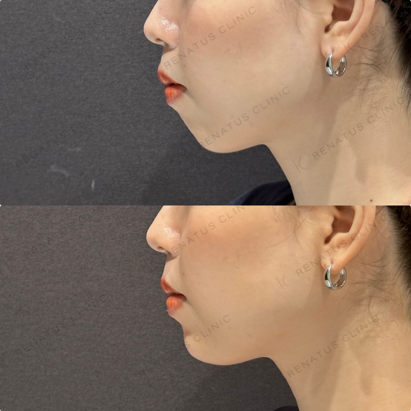 顎ヒアルロン酸ボラックス症例写真