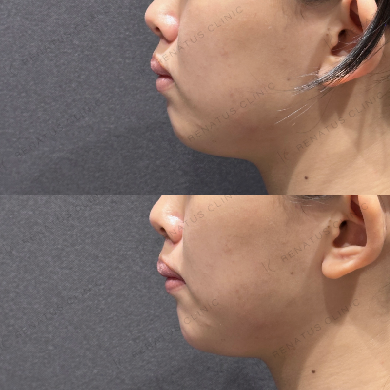 顎ヒアルロン酸ボラックス症例写真