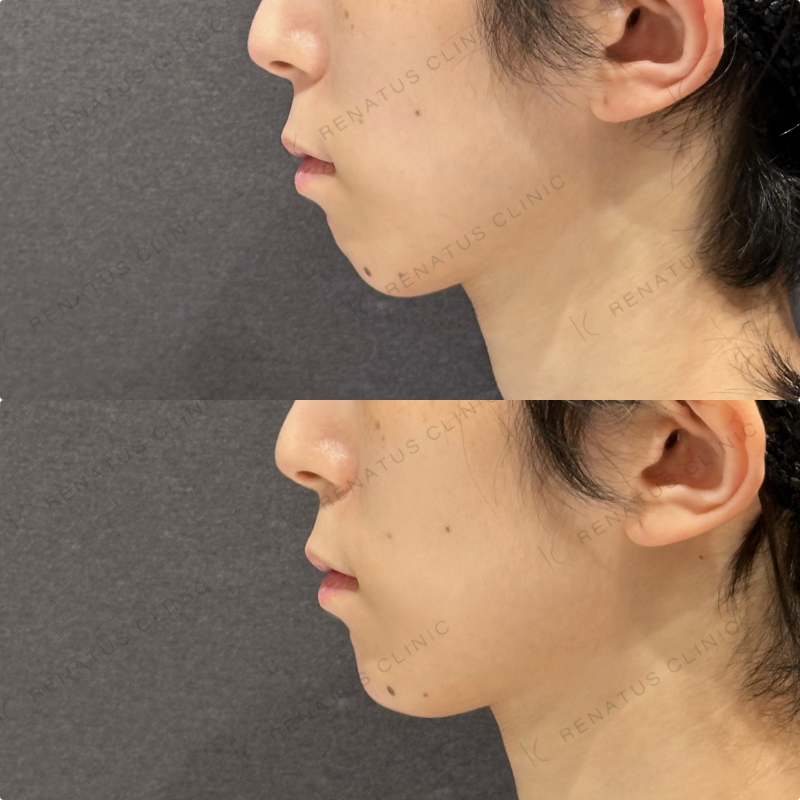 顎ヒアルロン酸ボラックス症例写真