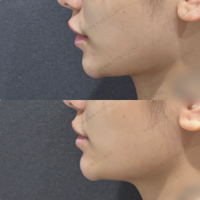 顎ヒアルロン酸ボラックス症例写真