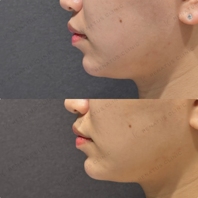 顎ヒアルロン酸ボラックス症例写真