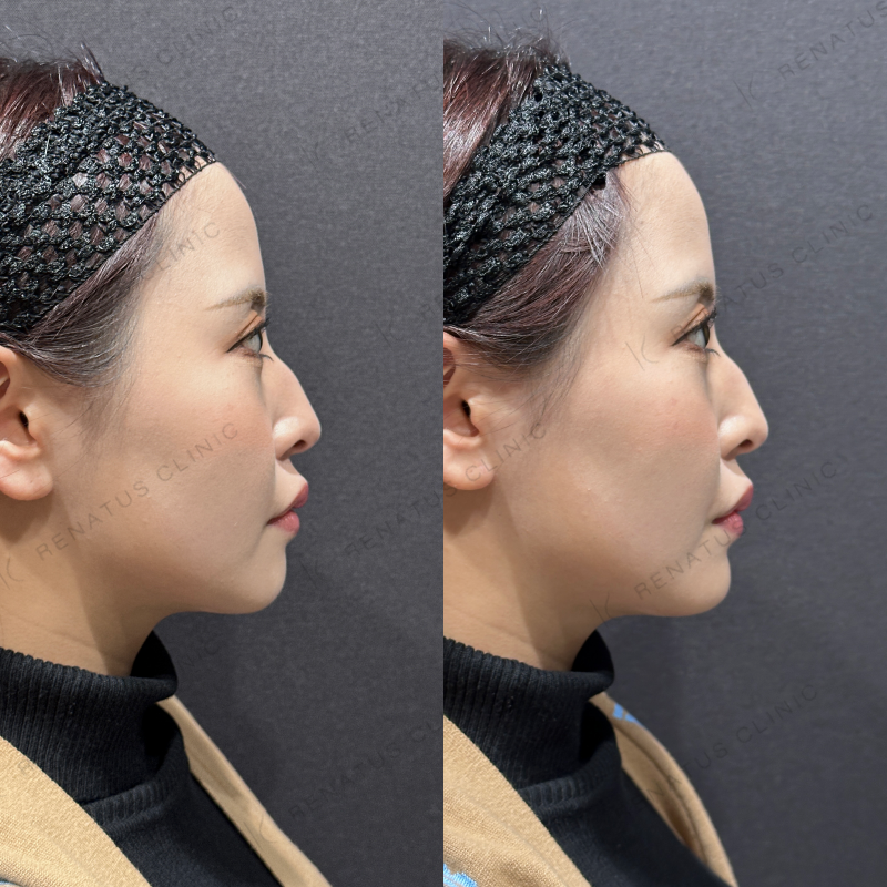 顎ヒアルロン酸ボラックス症例写真