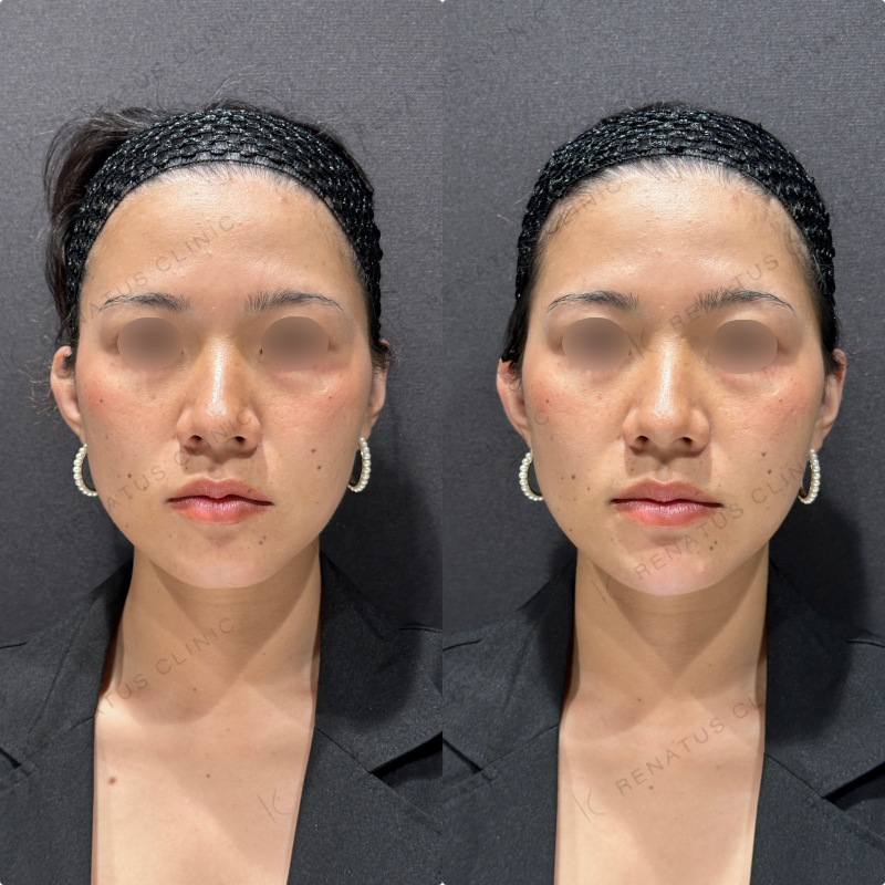 顎ヒアルロン酸ボラックス症例写真