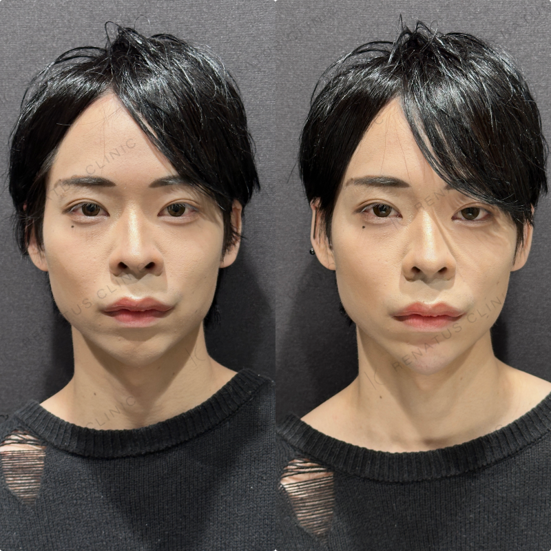 顎ヒアルロン酸ボラックス症例写真