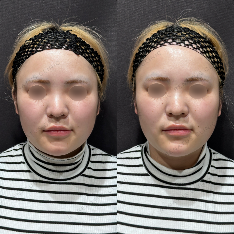 顎ヒアルロン酸ボラックス症例写真