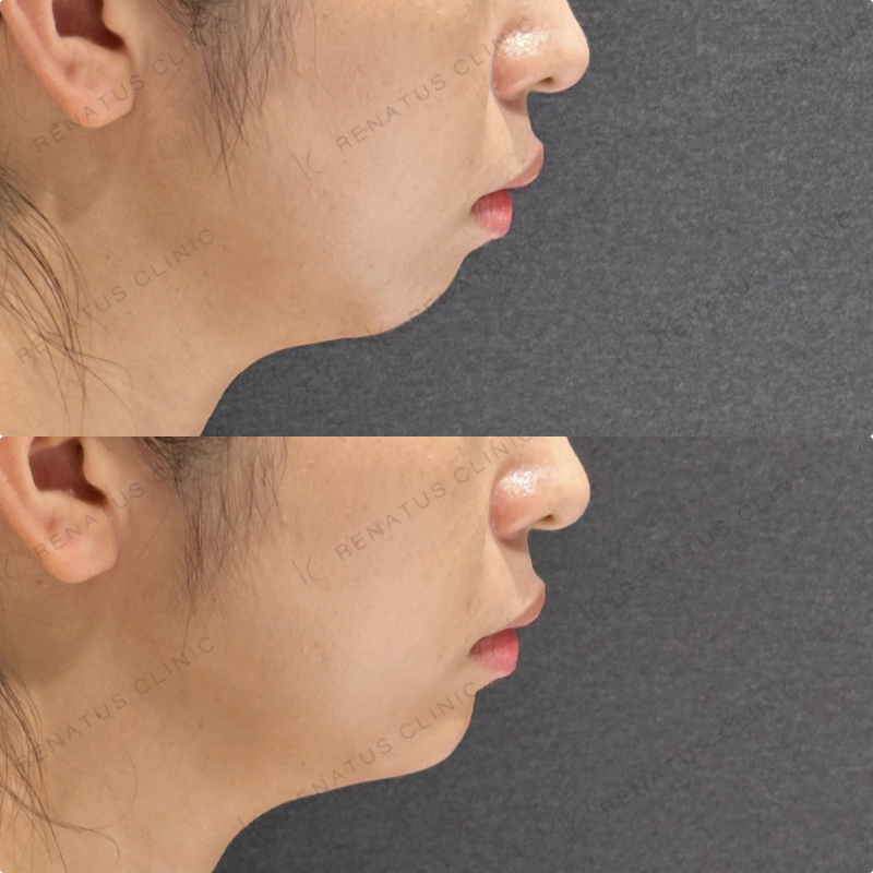 顎ヒアルロン酸ボラックス症例写真