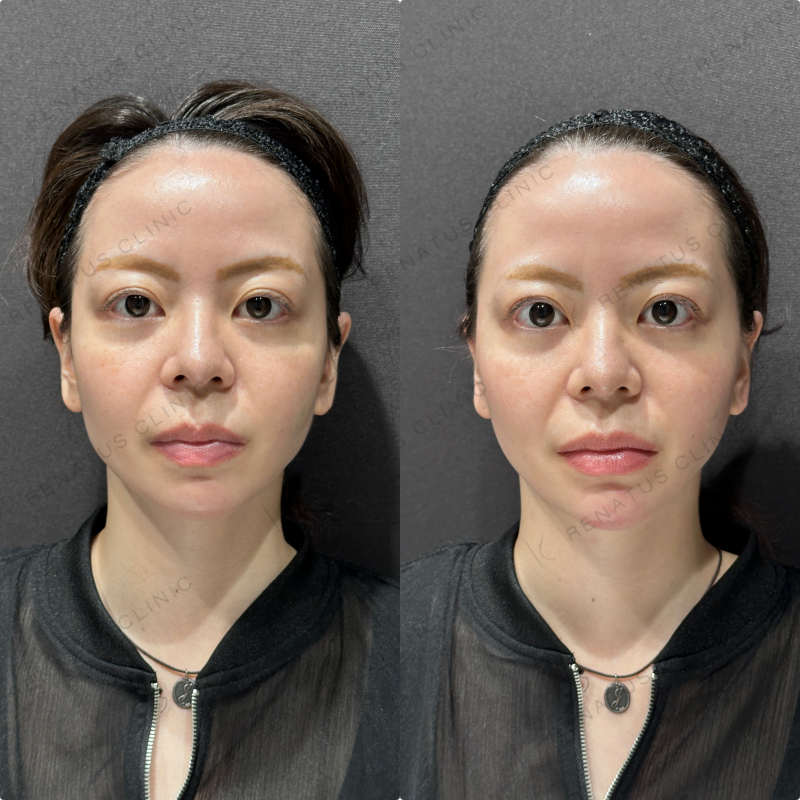 顎ヒアルロン酸ボラックス症例写真