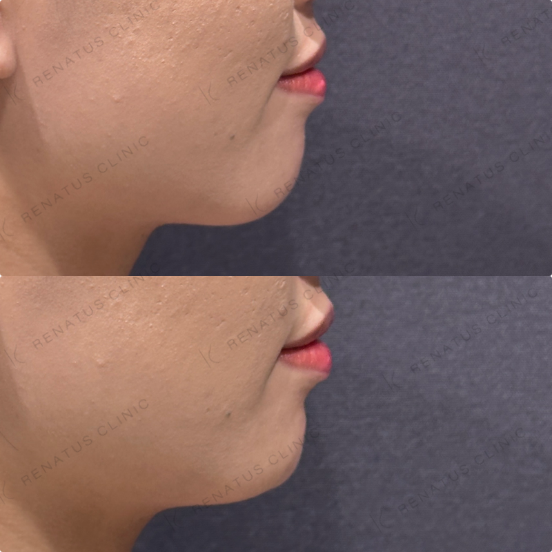 顎ヒアルロン酸ボラックス症例写真