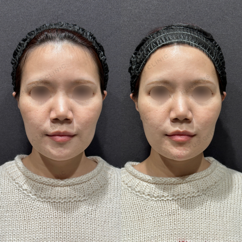 顎ヒアルロン酸ボラックス症例写真