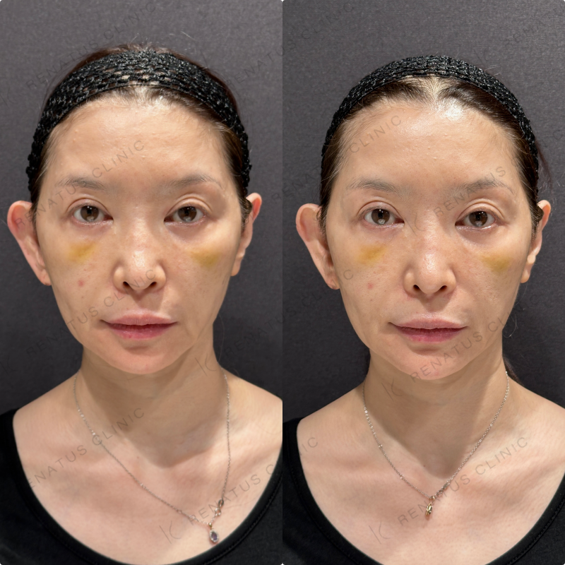 顎ヒアルロン酸ボラックス症例写真