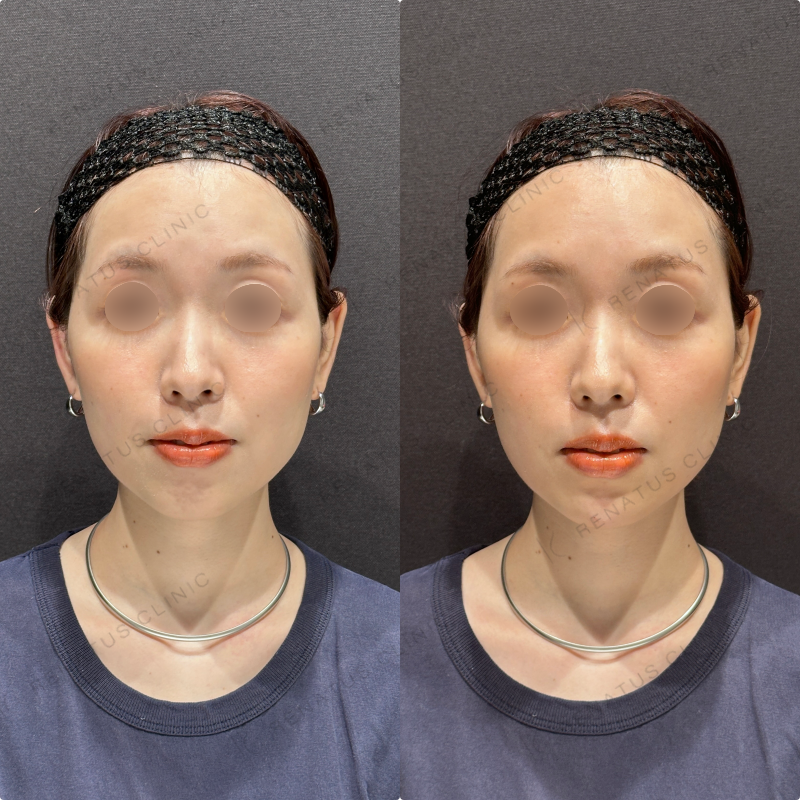 顎ヒアルロン酸ボラックス症例写真