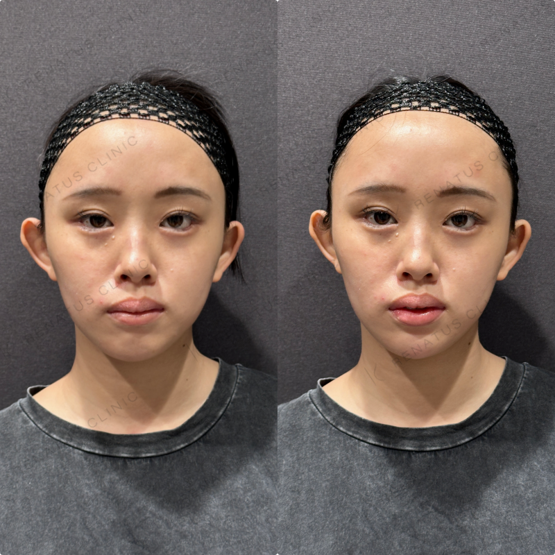 顎ヒアルロン酸ボラックス症例写真