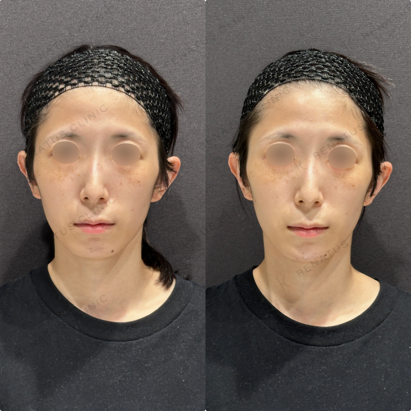 顎ヒアルロン酸ボラックス症例写真