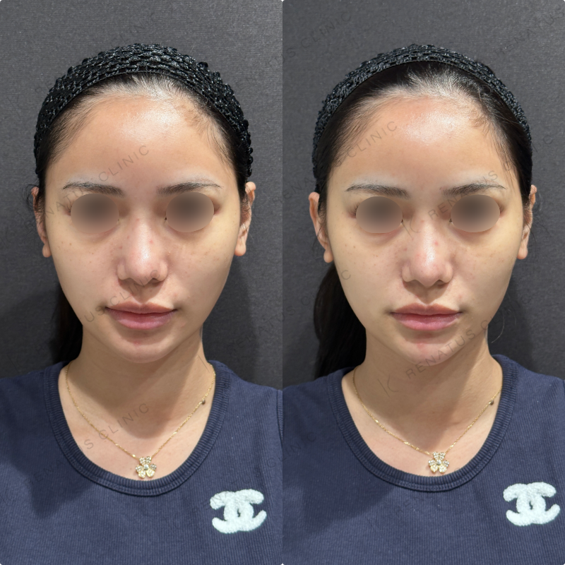 顎ヒアルロン酸ボラックス症例写真