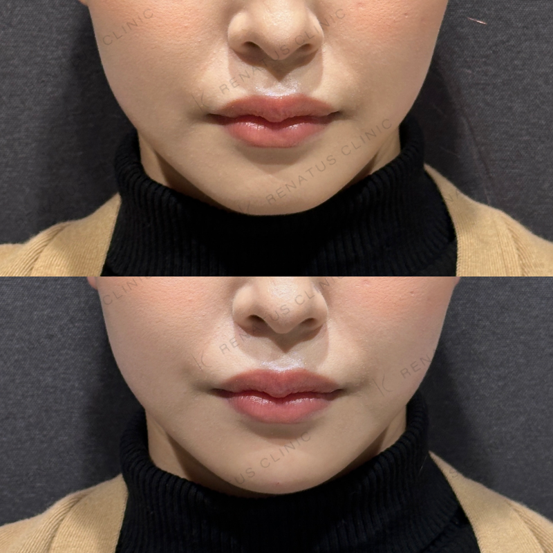 顎ヒアルロン酸ボラックス症例写真