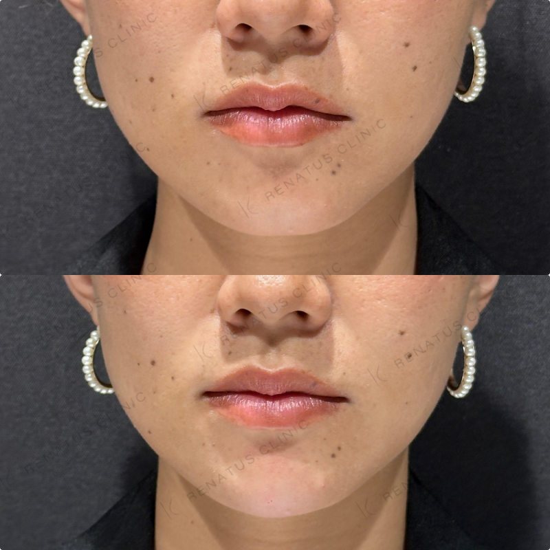 顎ヒアルロン酸ボラックス症例写真