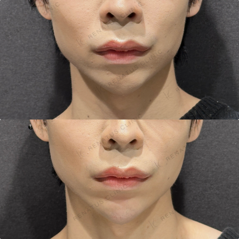 顎ヒアルロン酸ボラックス症例写真