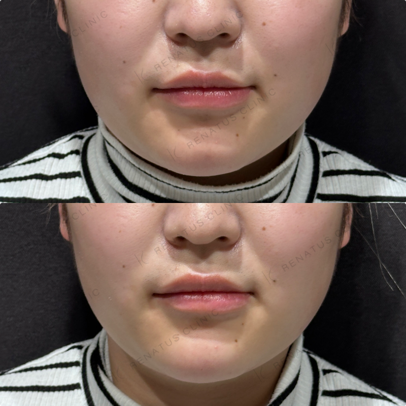 顎ヒアルロン酸ボラックス症例写真