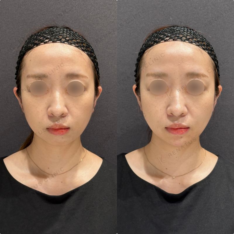 顎ヒアルロン酸ボラックス症例写真