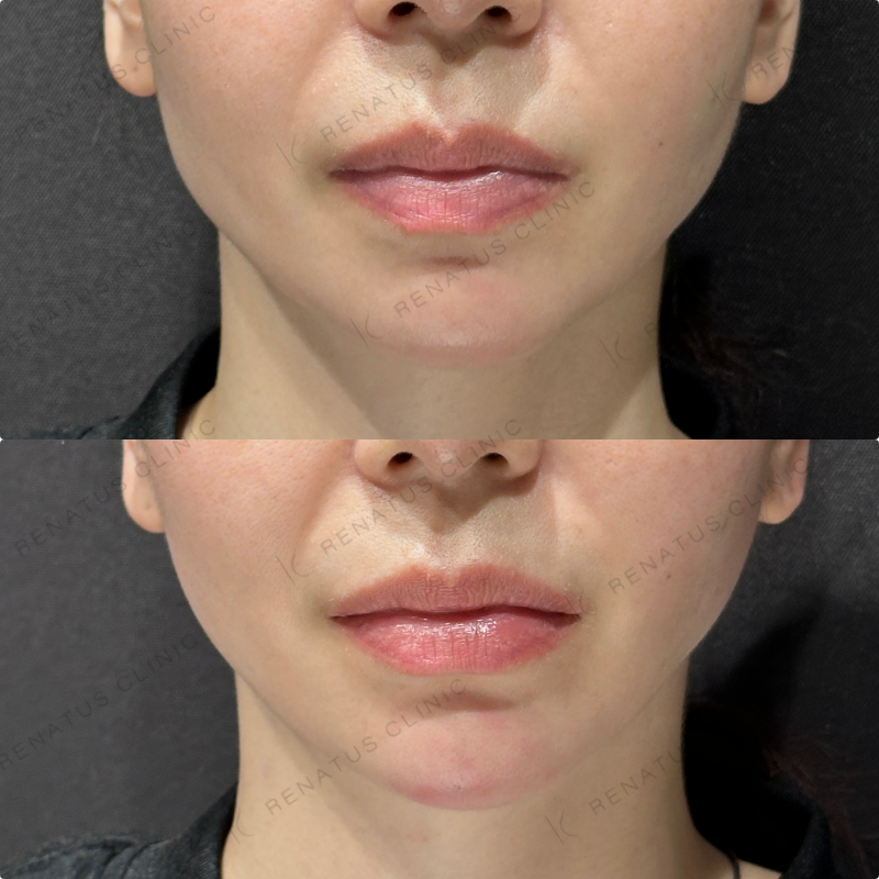 顎ヒアルロン酸ボラックス症例写真