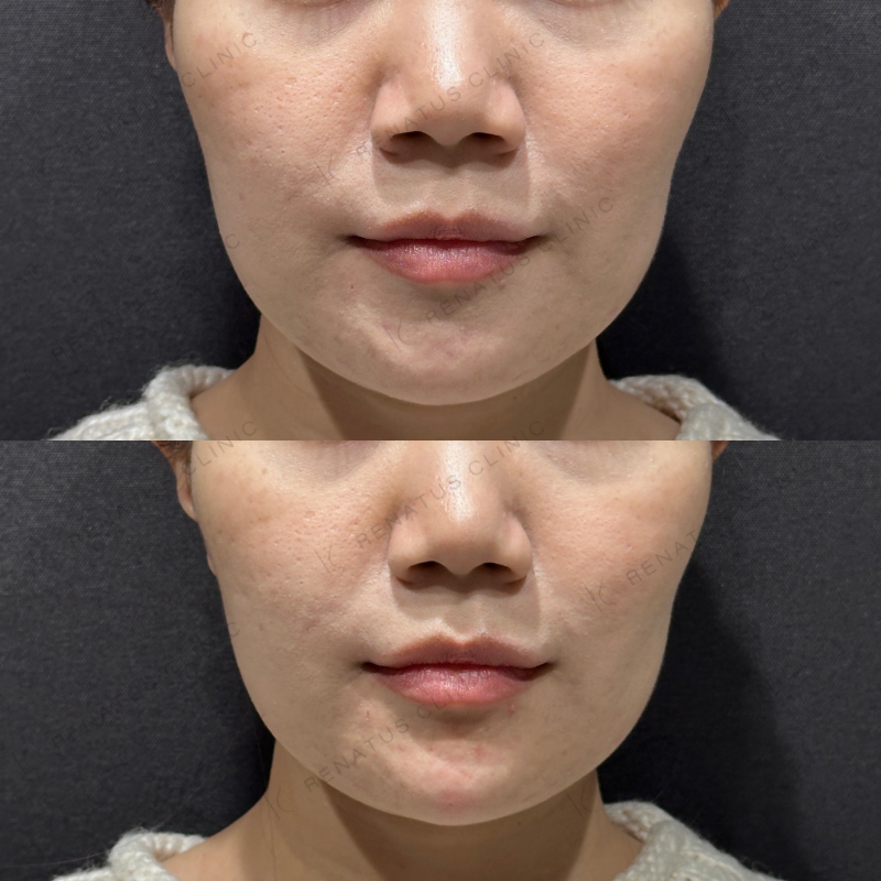 顎ヒアルロン酸ボラックス症例写真