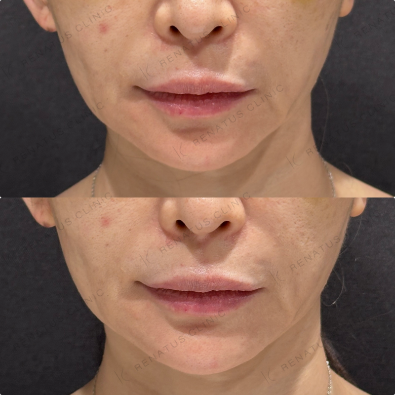 顎ヒアルロン酸ボラックス症例写真