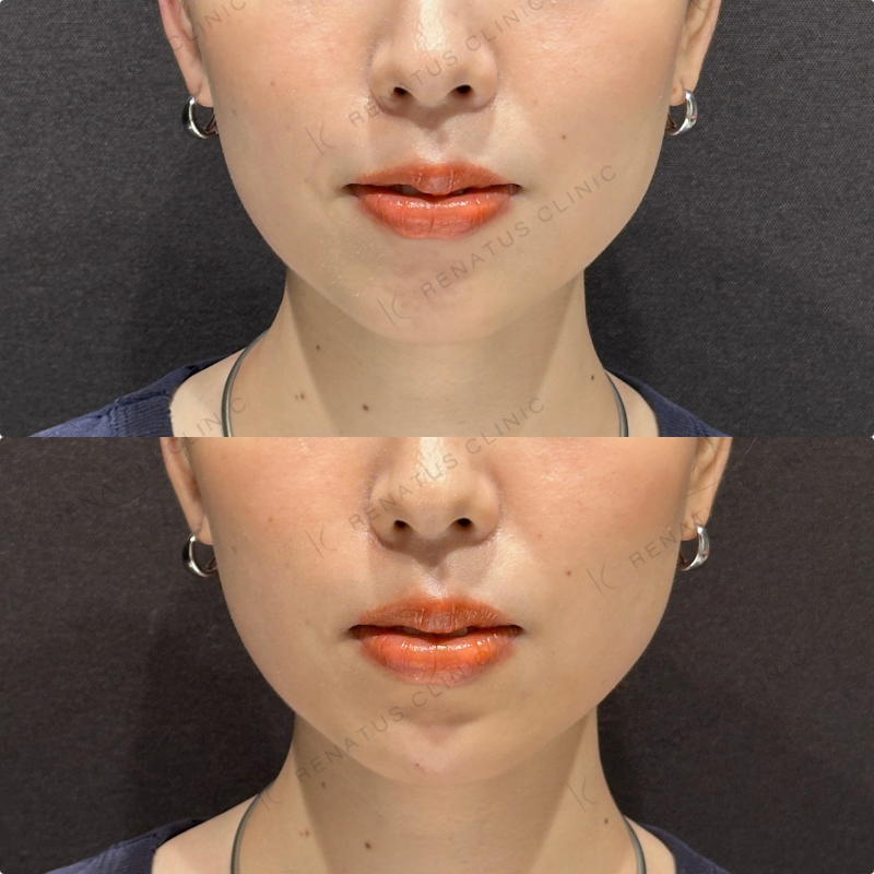 顎ヒアルロン酸ボラックス症例写真