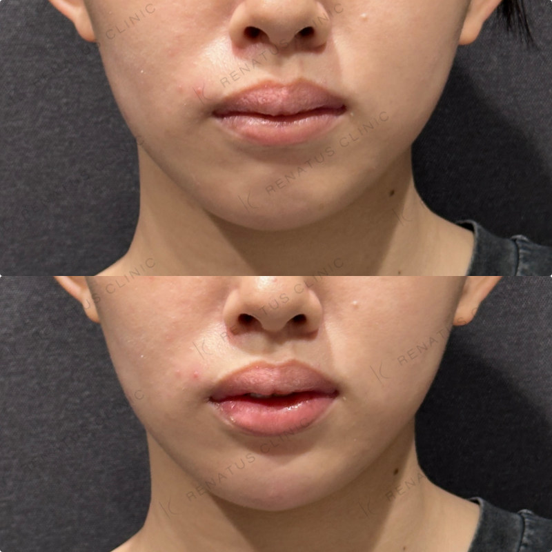 顎ヒアルロン酸ボラックス症例写真