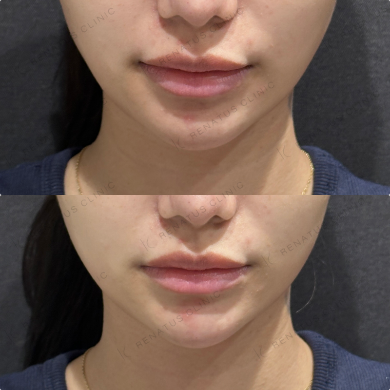 顎ヒアルロン酸ボラックス症例写真