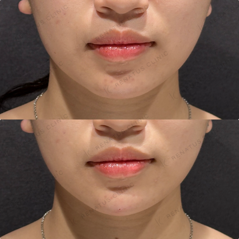 顎ヒアルロン酸ボラックス症例写真