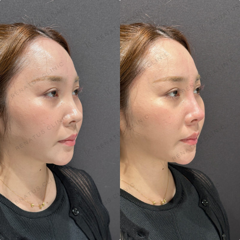 鼻根・鼻筋・鼻中隔ヒアルロン酸ボラックス症例写真