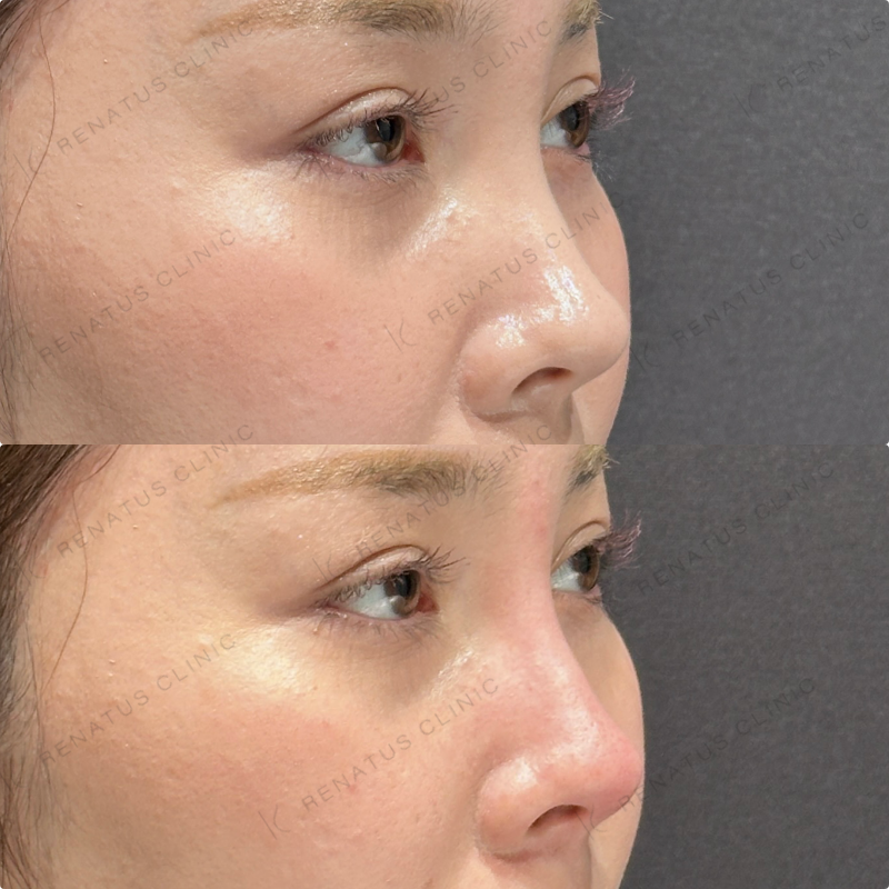 鼻根・鼻筋・鼻中隔ヒアルロン酸ボラックス症例写真