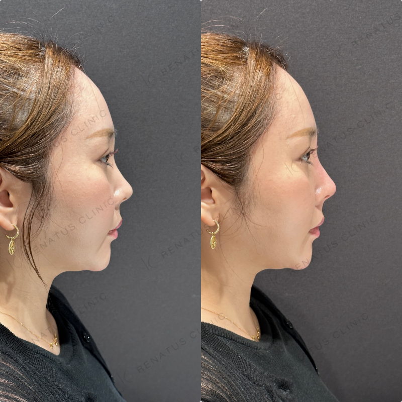 鼻根・鼻筋・鼻中隔ヒアルロン酸ボラックス症例写真