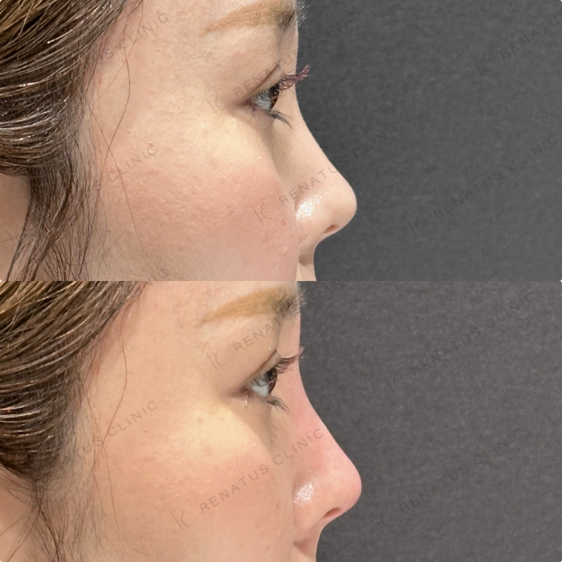 鼻根・鼻筋・鼻中隔ヒアルロン酸ボラックス症例写真