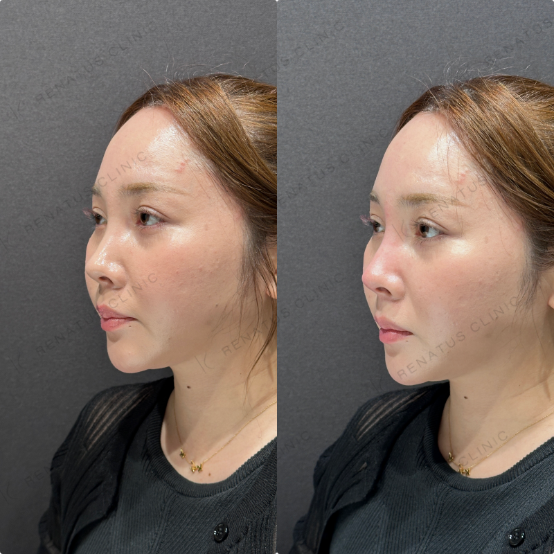 鼻根・鼻筋・鼻中隔ヒアルロン酸ボラックス症例写真