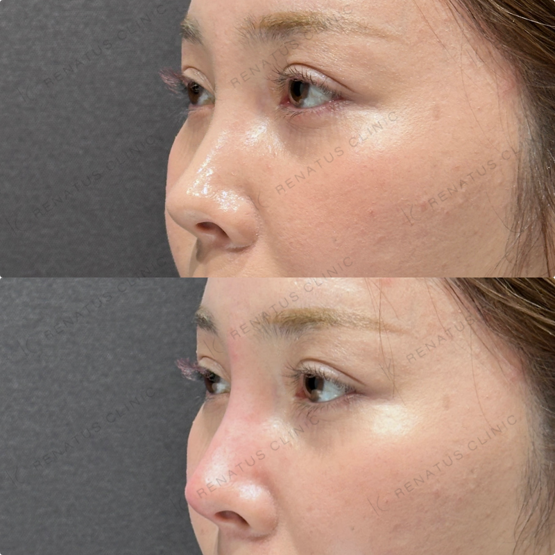 鼻根・鼻筋・鼻中隔ヒアルロン酸ボラックス症例写真