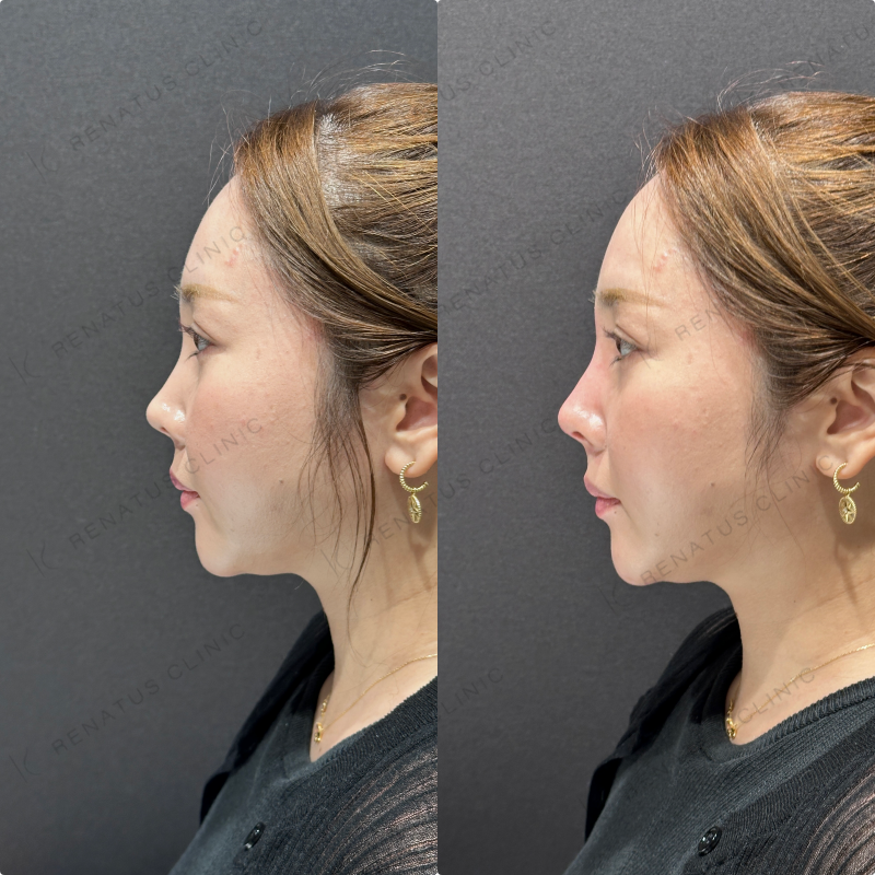 鼻根・鼻筋・鼻中隔ヒアルロン酸ボラックス症例写真